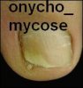 onychomycose.jpg