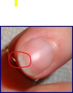 comment reparer un ongle fendu horizontalement