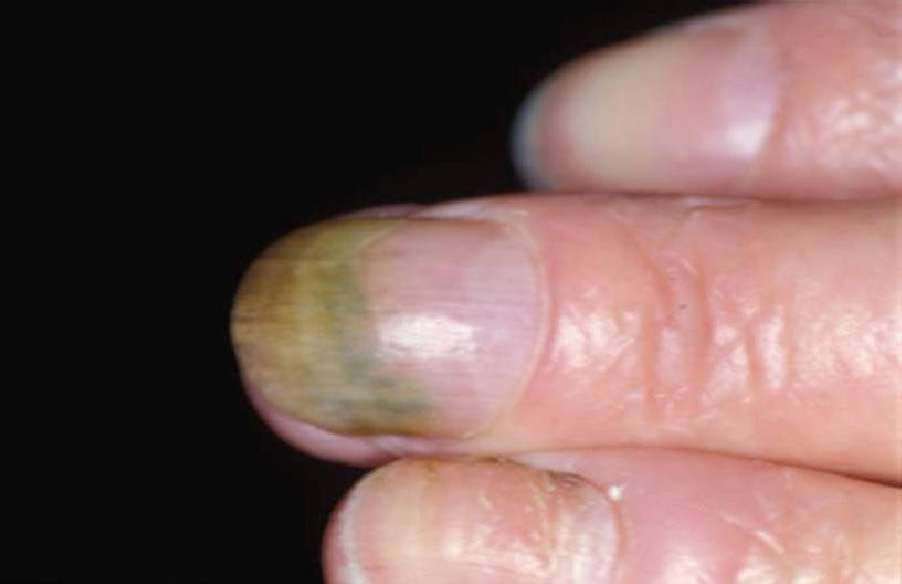 Mais pas dangereux !! Causé la plupart du temps par la technicienne, manque d\u0027hygiène, mauvaise préparation de l\u0027ongle, mauvaise maîtrise du ratio, etc.