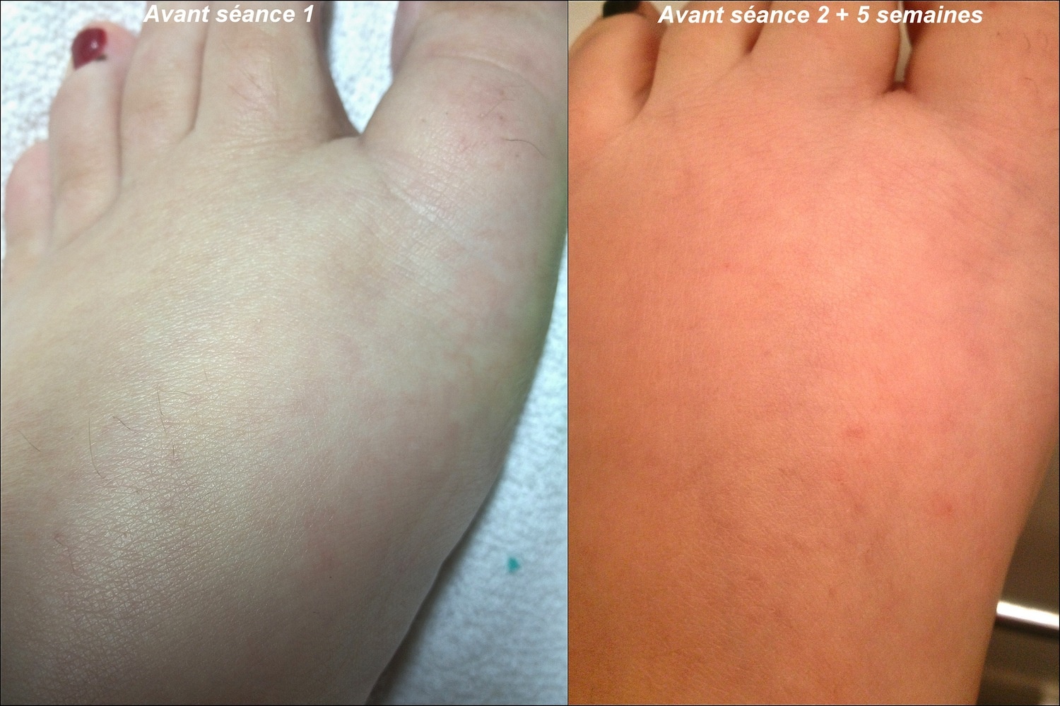 avant après orteil.jpg