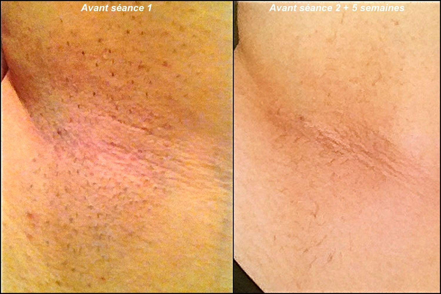 avant après séance 2 aisselles.jpg