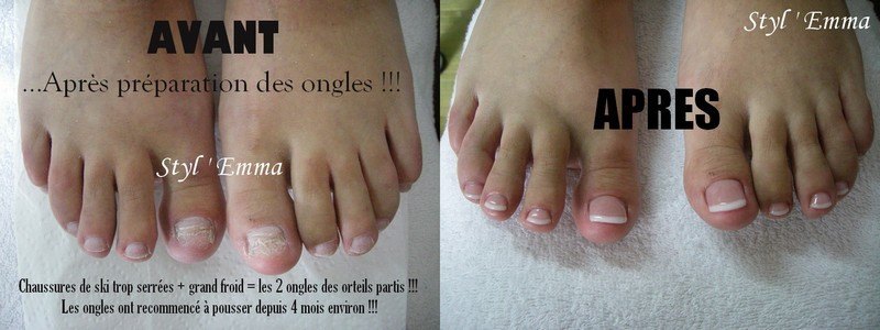 AVANT APRES pieds.jpg