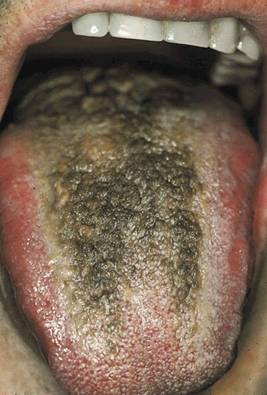 cancer de la langue.jpg