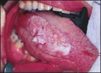 langue-cncer-stop-tabac-ch.jpg