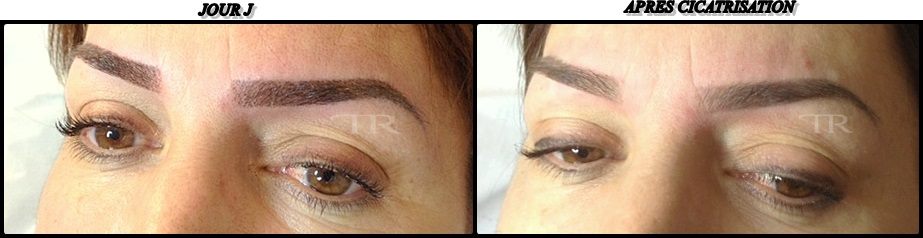 micropigmentation cicatrisation avant apres.jpg