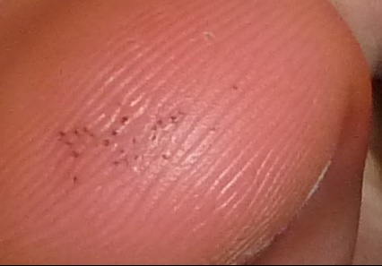 petit point noir sur orteil.jpg