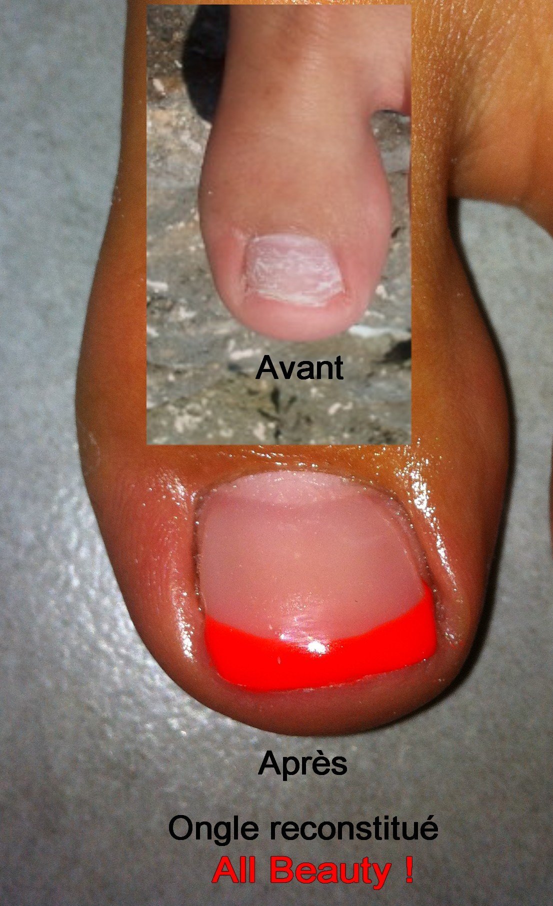 photo protégée cécilia orteil reconstitué.jpg