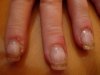 problème ongles..JPG