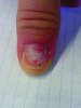ongle cassé.jpg