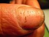 Nail_Pitting_1_030319.jpg