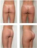 buttock-implant1.jpg
