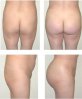 buttock-implant3.jpg
