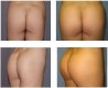 buttock-implant4.jpg