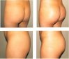 buttock-implant2.jpg
