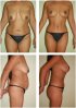 breast-lift10.jpg