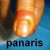 panaris.jpg