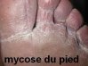 mycose-du-pied.jpg