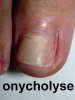 onycholyse.jpg