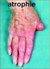atrophie.jpg