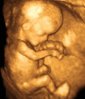 Echographie-3D-11-semaines-image-réduite.jpg