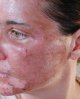 Chemical-Peels-and-Acne-950x1180.jpg