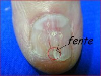 5743-ongle_fendu.jpg