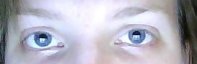yeux.. j+2.jpg