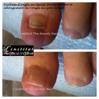 résine prothèse orteil.JPG