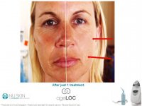 Visage gels 1 traitement.JPG