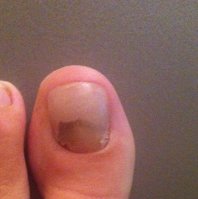 Oongle avec resine.JPG