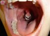normal_pierced.jpg